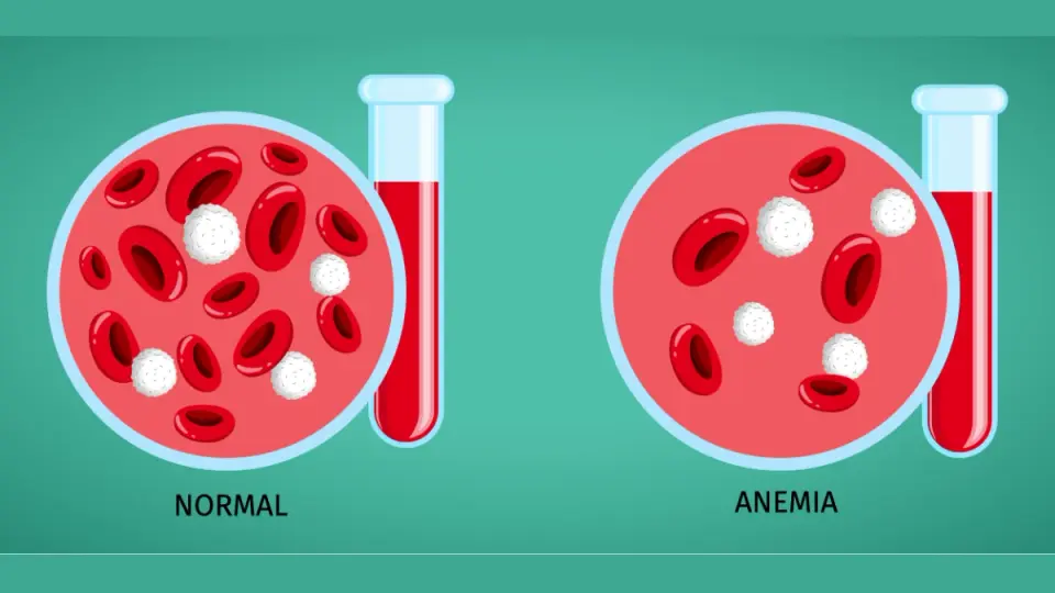 Anemia – Schematic illustration showing red blood cells and oxygen transport